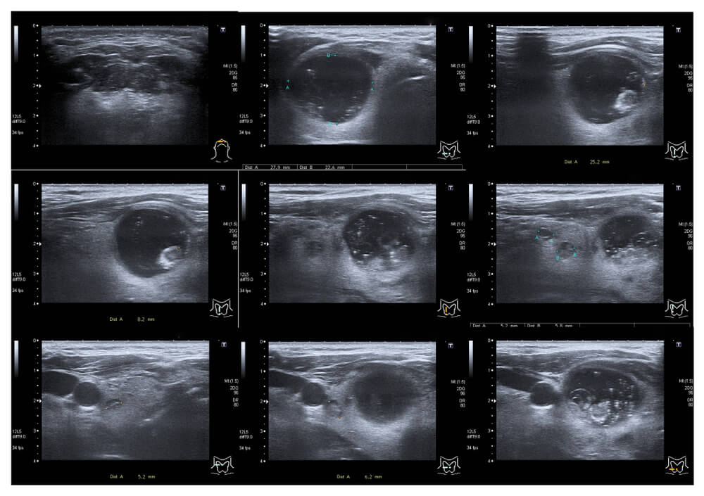 Normal Thyroid Ultrasound