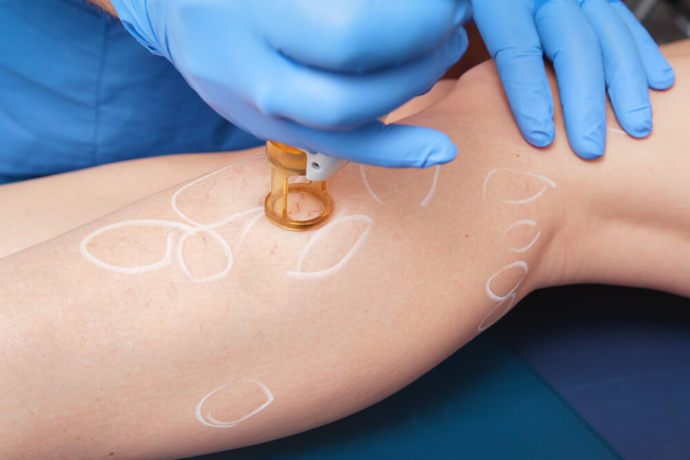 Doctor Performing Laser Varicose Vein Treatment on a Woman's Leg