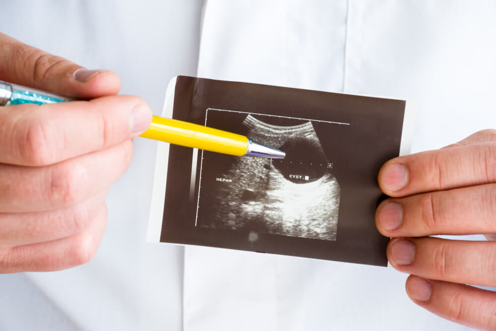 Doctor pointing with a pen on Printed Picture Ultrasound Pathology - Hepatic Cyst With Cavity