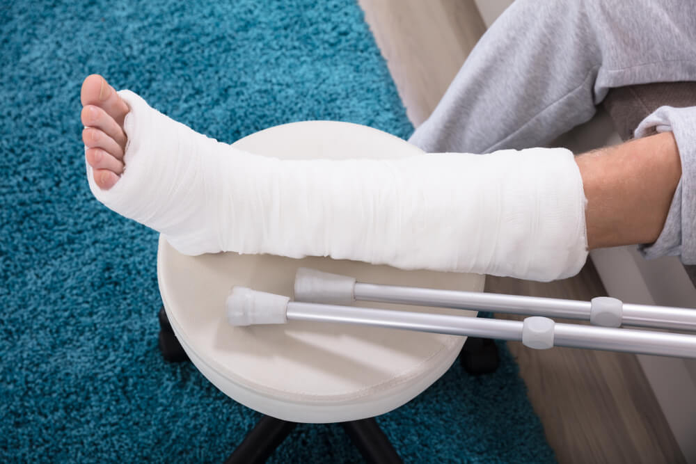 Elevated View Of Man's Broken Leg In Cast