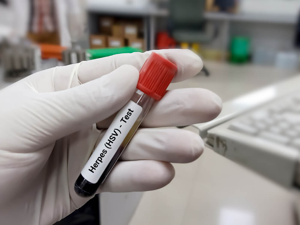 Test Tube With Blood Sample for Herpes Test, Herpes Simplex Virus (Hsv). 