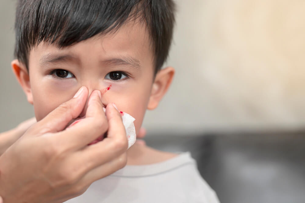 Portrait Of Cute Asian Ethnic Child Having Nosebleedthe Concept Of First Aid For Nosebleeds