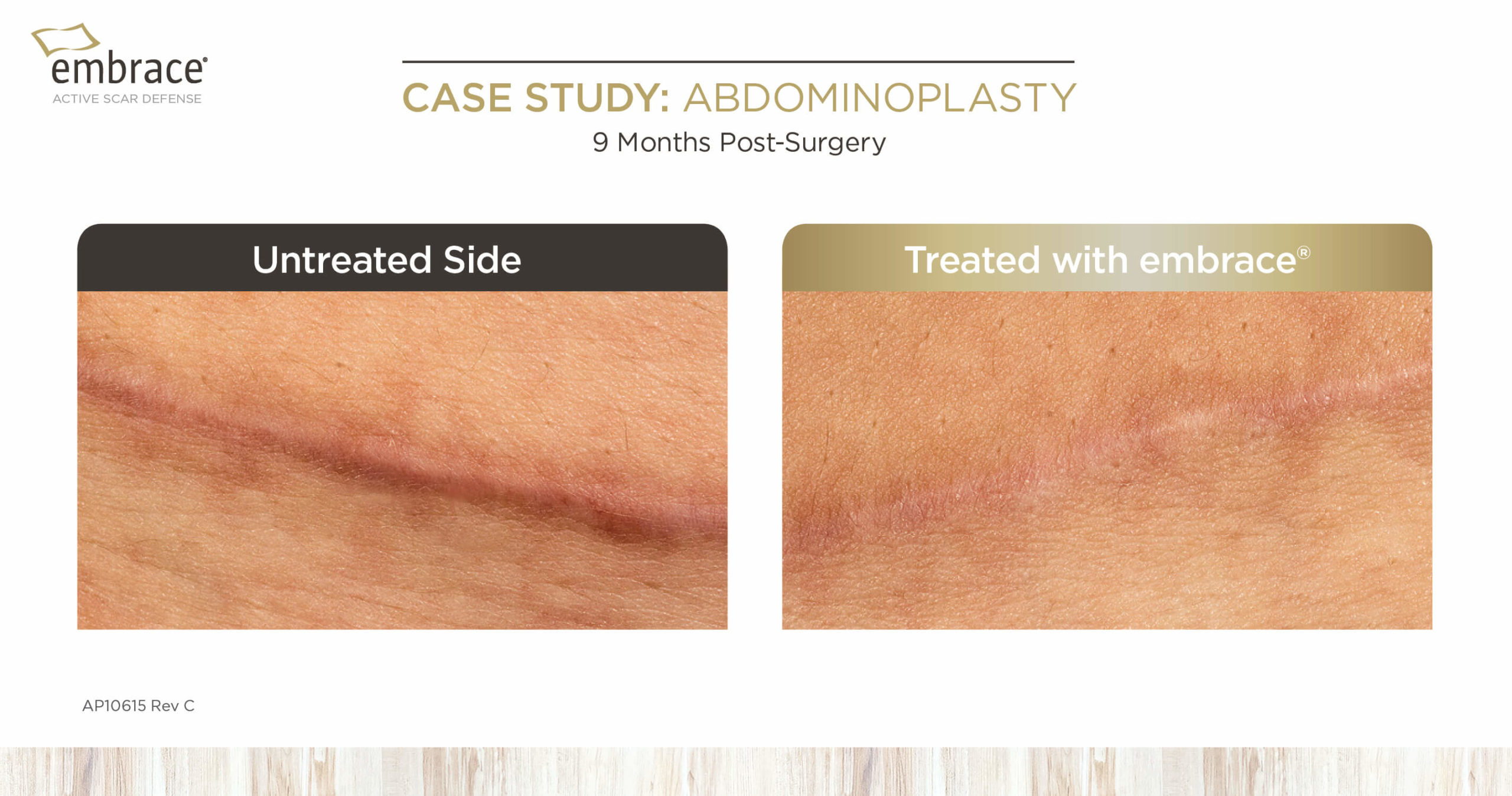 Abdominoplasty untreated vs treated with embrace