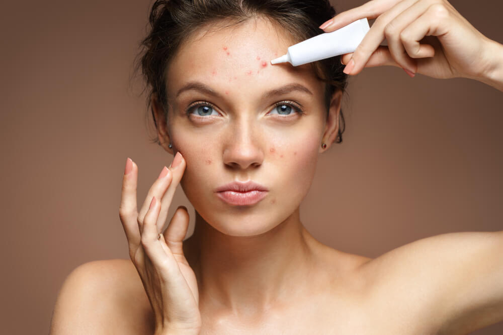 Teen Girl With Problem Skin Applying Treatment Cream on Beige Background.