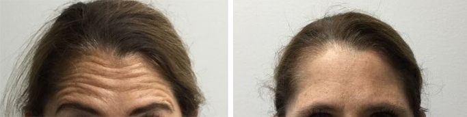 BeforeAfter
