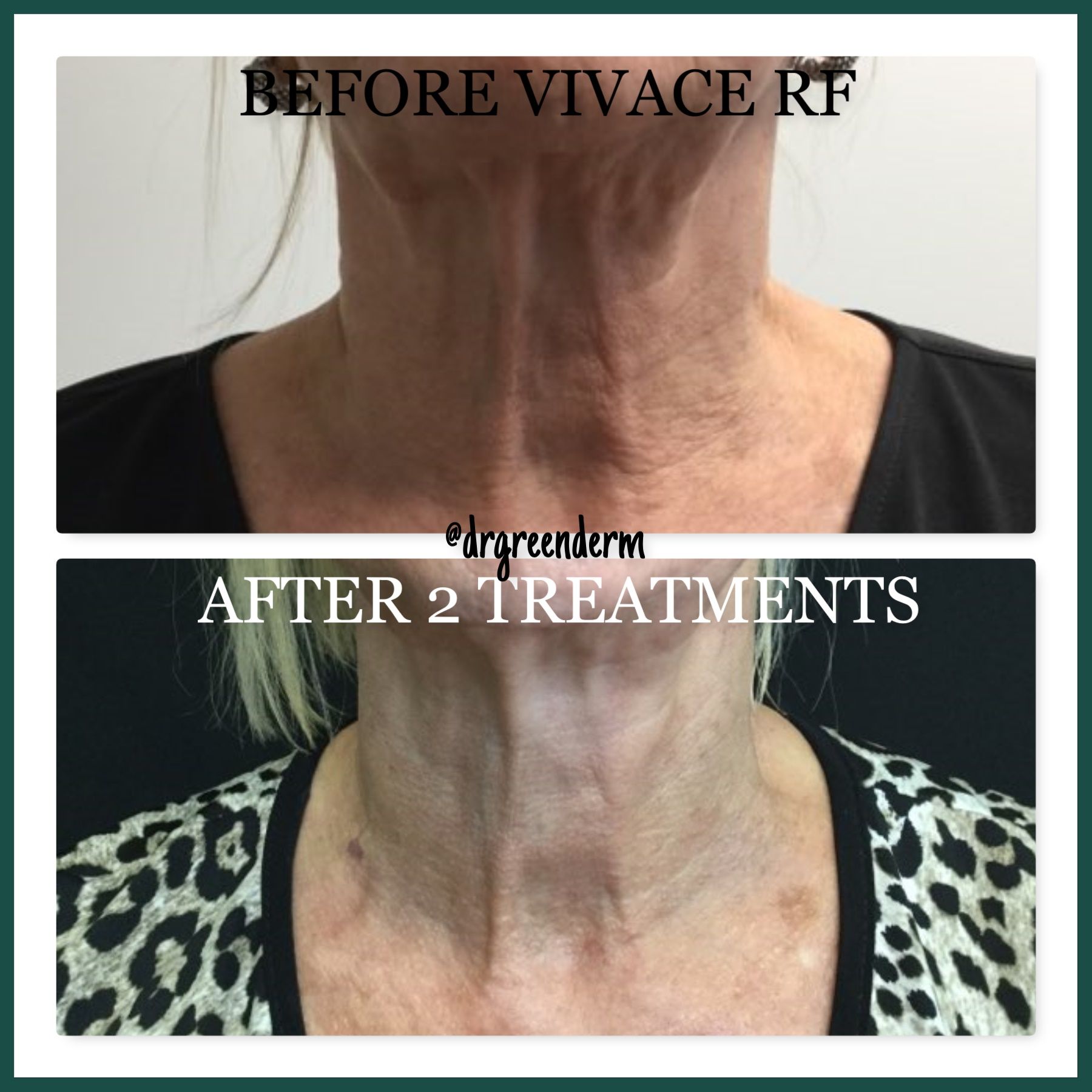 DEAKTER_B_A | Green Dermatology