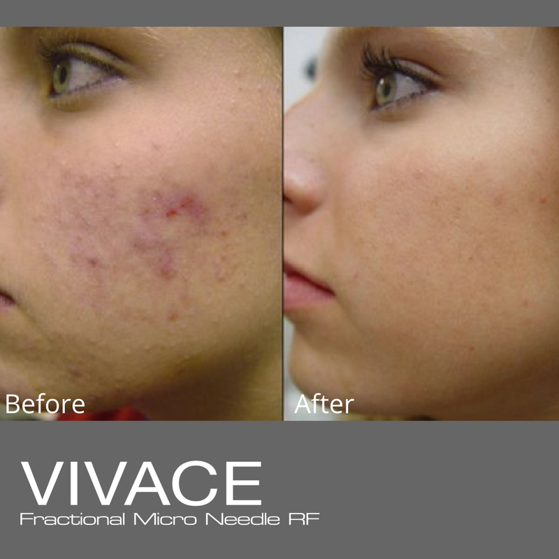 Vivace_B_A_female_cheek_acne | Green Dermatology