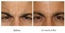 dysport_copy | Green Dermatology