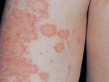 eczema