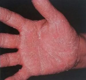 eczema_2_300x279