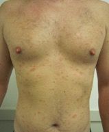 pityriasis_rosea