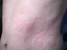 uticaria