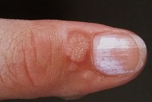 warts2_300x202