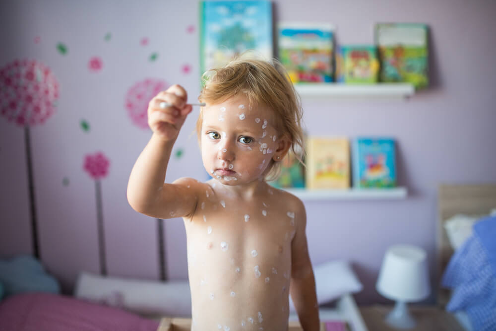 Little Girl With Chickenpox, Antiseptic Cream Applied to Rash