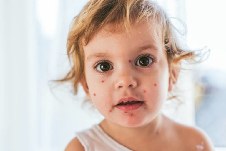 8 Common Skin Rashes in Children Green Dermatology