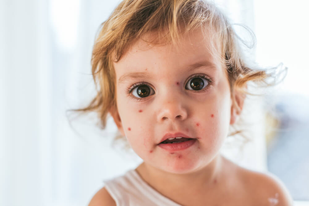 Closeup of Cute Little Girl. Varicella Virus or Chickenpox Bubble Rash on Child