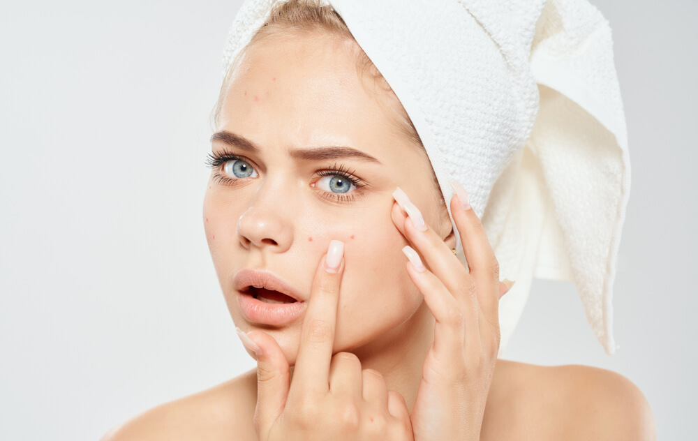 Woman With a White Towel on Her Head Squeezes Acne on Her Face