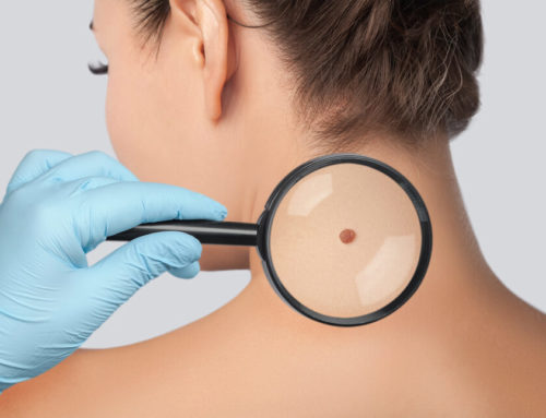 Superficial Radiotherapy: Learn More About This Painless Skin Cancer Treatment