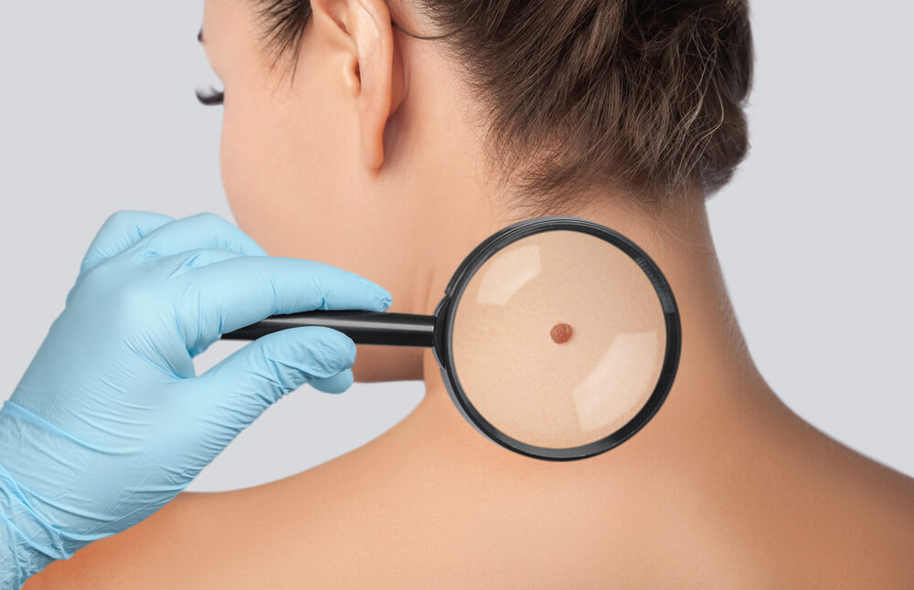 The Doctor Examines a Large Mole on the Shoulder With a Magnifying Glass in the Clinic.