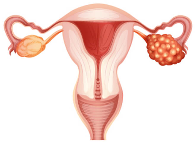 urinary-incontinence