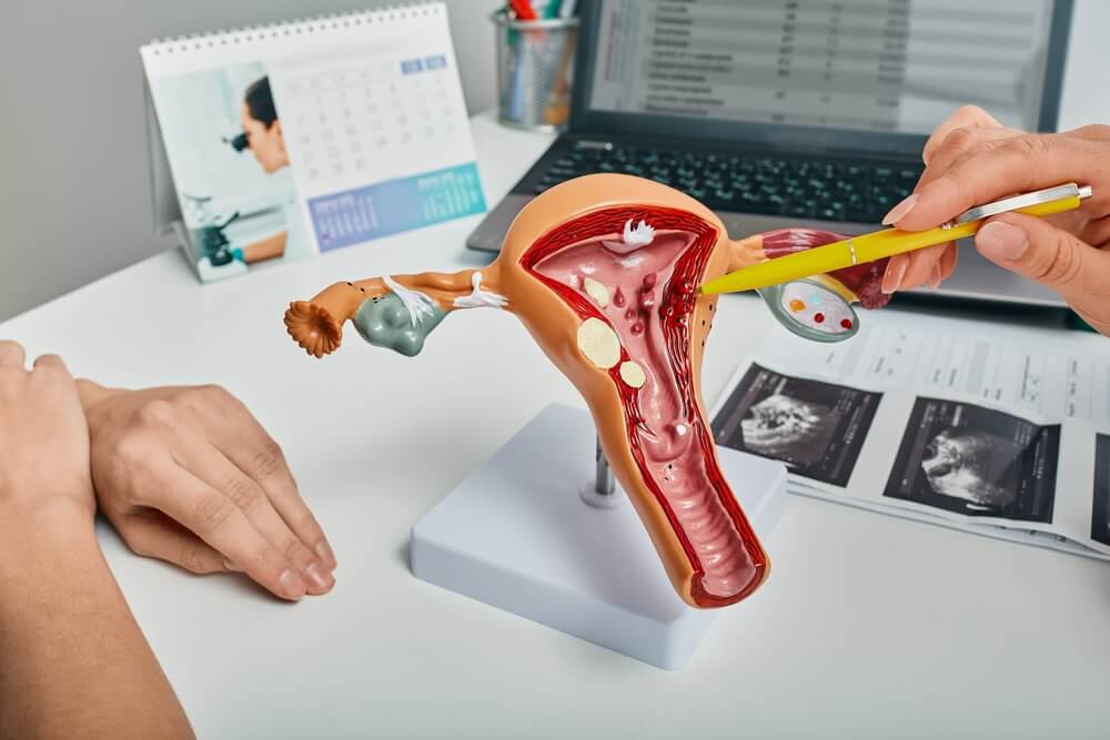 Gynecologist Showing Polyps of Endometrium of Uterus Using Anatomical Model During Consultation to Female Patient.
