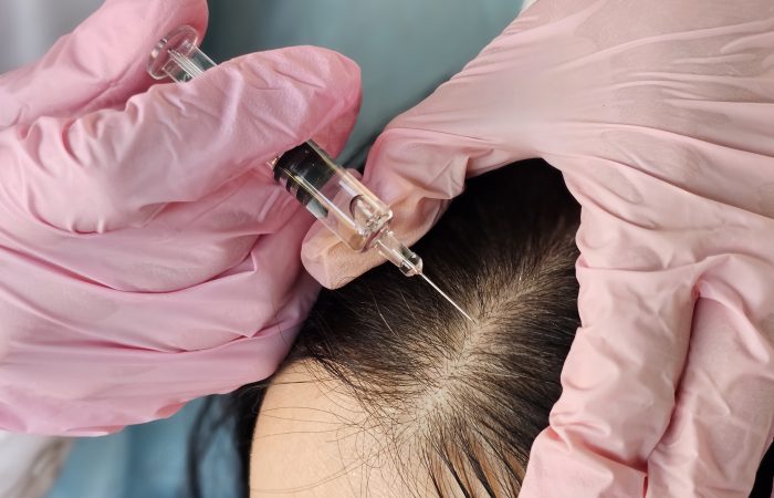 PRP Therapy