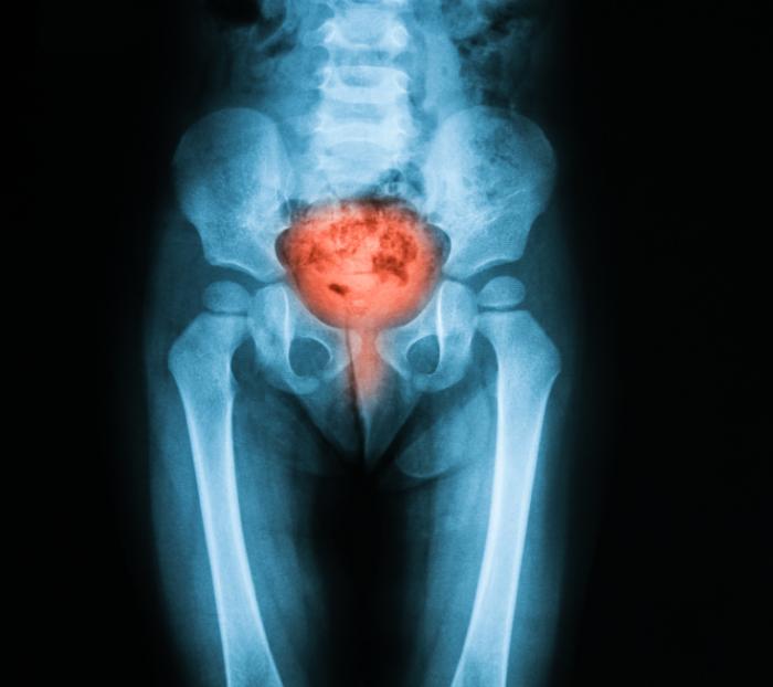 X-ray of the Bladder and Abdomen