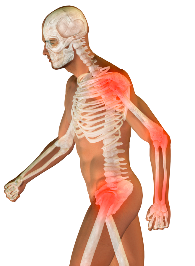 Illustration of Human's Body With Skeleton and Inflamed Joints in it