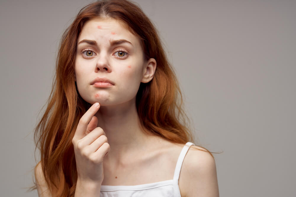Redheaded Woman Shows Fingers on Acne on Her Face