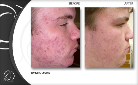 acne_1 (1)