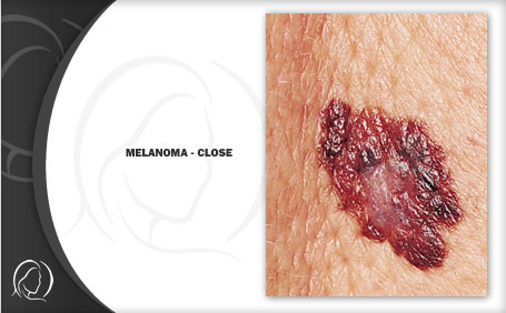 melanoma_02