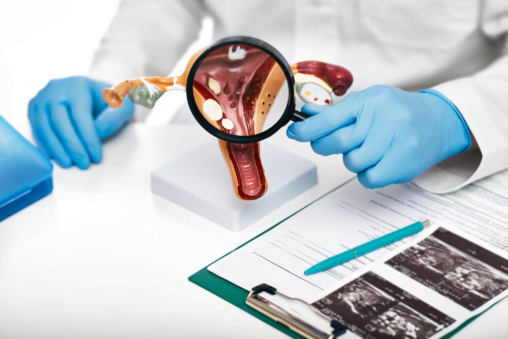 Close-up anatomical model of the uterus with pathologies. Gynecologist showing the polyps of the uterus. Gynecological diseases and treatments