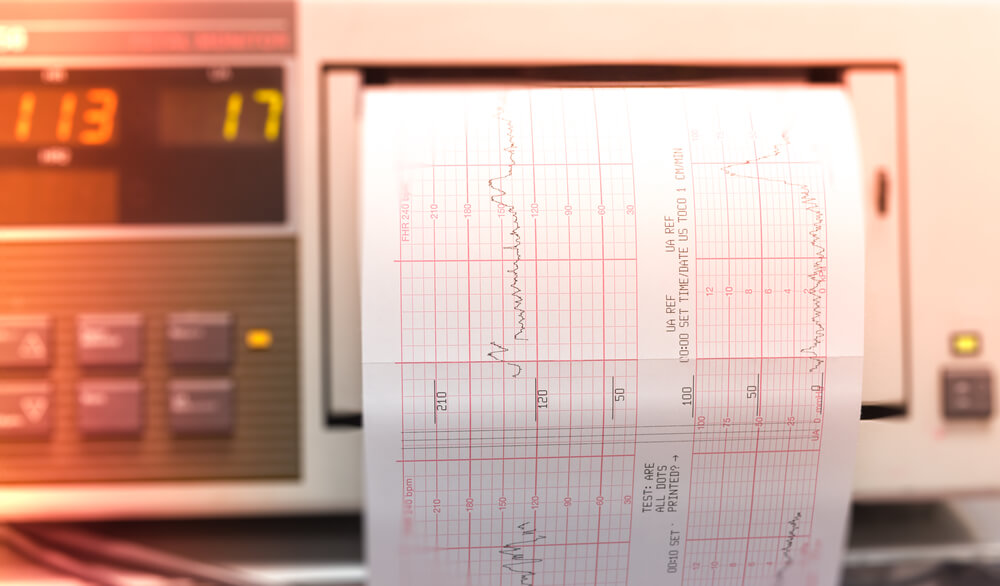 Printing of Cardiogram Report Coming Out From Electrocardiograph Iin Delivery Room