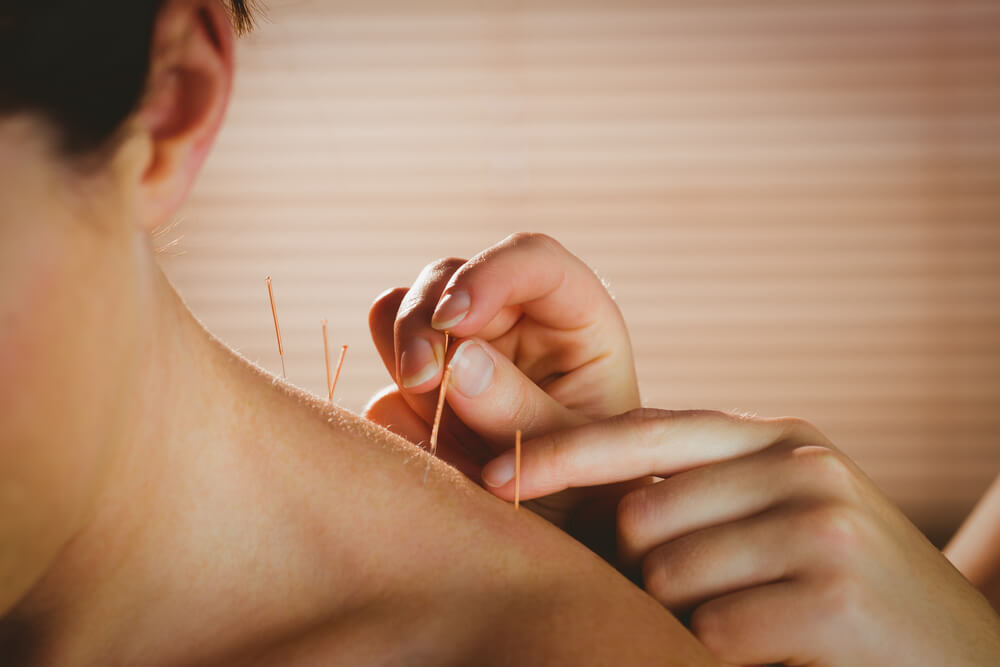 Young Woman Getting Acupuncture Treatment in Therapy Room