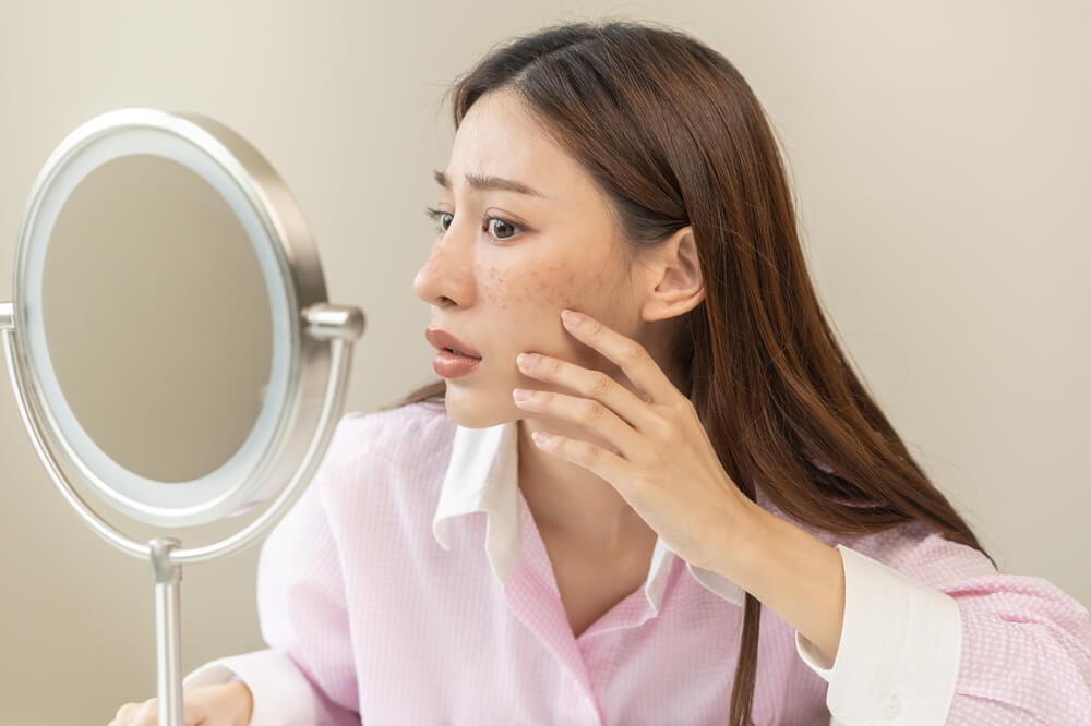 Dermatology, Expression Face Worry Asian Young Woman Looking Mirror Hand Touch Facial at Dark Spot of Melasma, Freckles From Pigment Melanin, Allergy Sun.