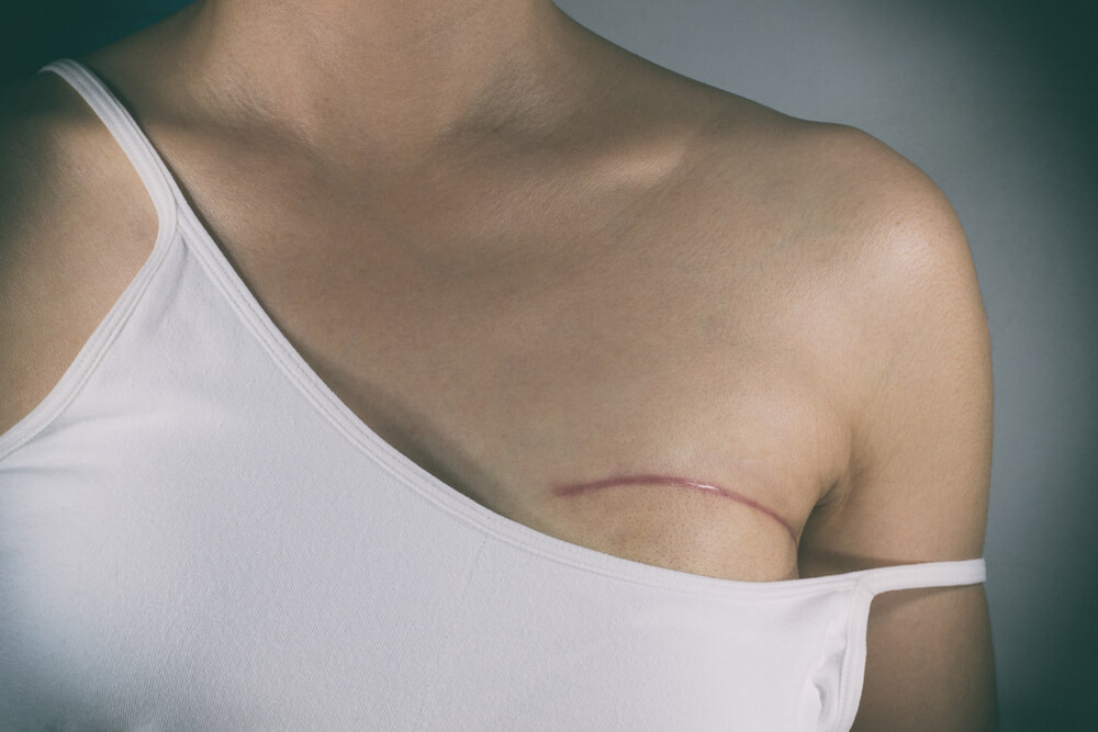 Breast Cancer Surgery Scars by Partial Mastectomy.