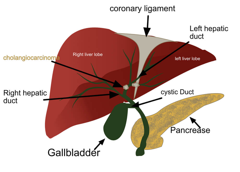The Structure of Liver Gallbladder and Pancreas With the Name of the Organ and Cholangiocarcinoma That It Is Presenting in the Located of Bile Duct