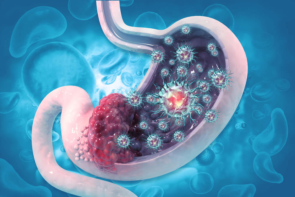 Stomach Cancer. Cancer Attacking Cell. Stomach Disease Concept