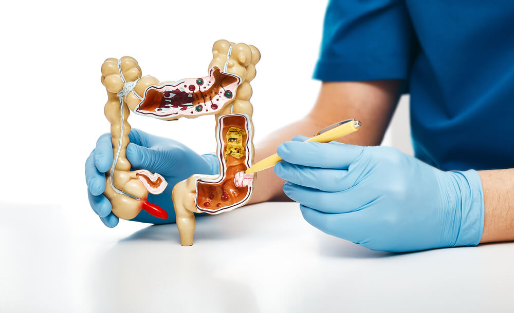 Gastroenterologist Pointing Pen Tumor Colon Using an Anatomical Model for Medical Education