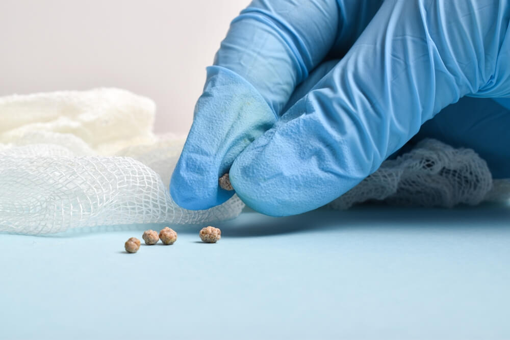 The Surgeon Holds the Removed Stones After the Operation Laparoscopic.