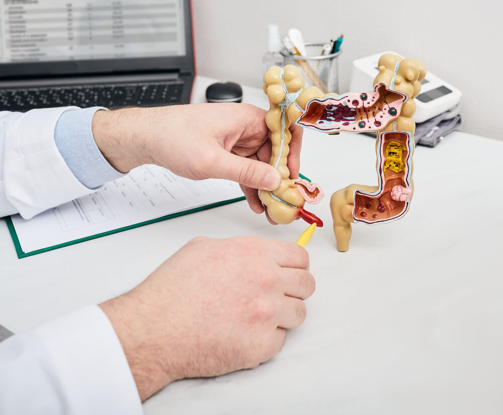 Doctor Pointing Pen to Inflamed Appendicitis Using a Intestines Anatomical Model