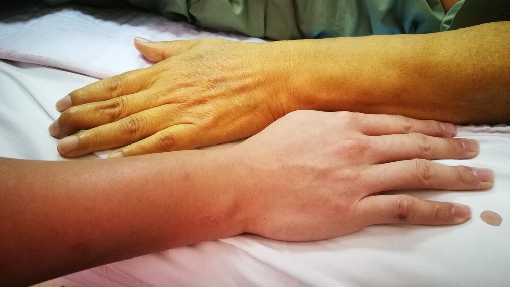 Jaundice Patient With Yellowish Discoloration Of Skin In Comparison With Normal Skin Color