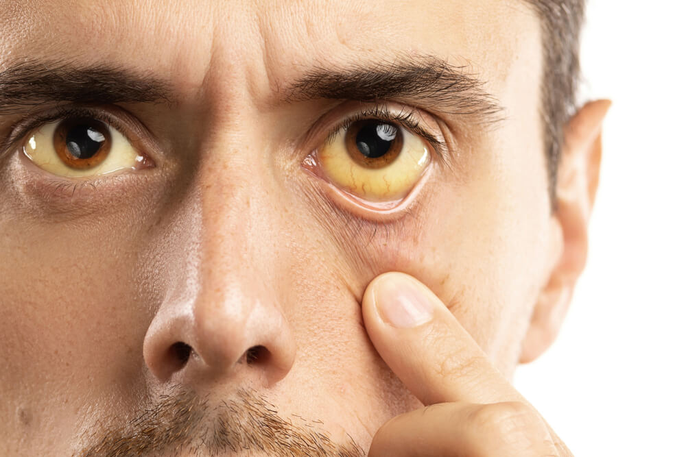 Man checking his health Condition Yellowish Eyes is Sign of Problems With Liver Viral Infection or Other Disease