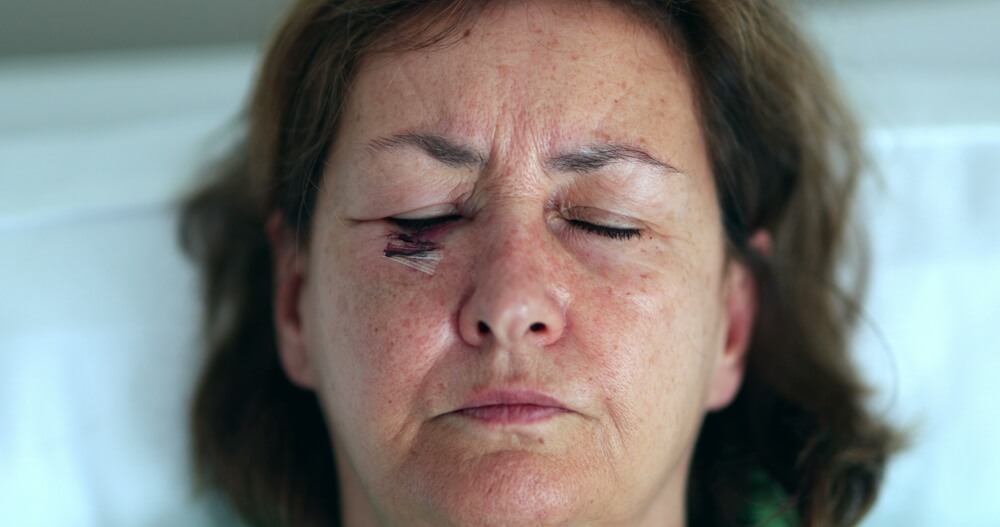 Older Woman With Bruise Scar Face Opening Eyes Looking To Camera
