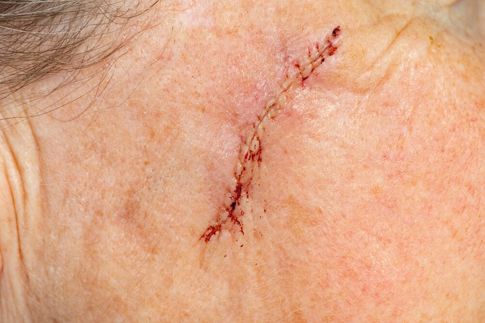 Stitched Up Wound After Mohs Surgery For Skin Cancer