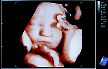 Ultrasound Image