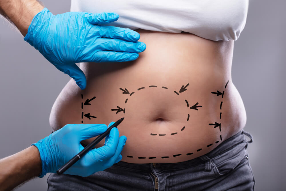 Close-up Of Plastic Surgeon In Blue Gloves Drawing On Woman's Stomach With Pen For Surgery