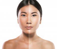 Skin Discoloration