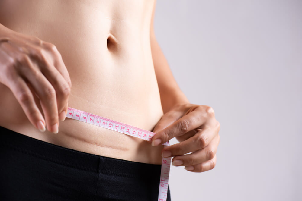 Closeup of Woman Showing on Her Belly Dark Scar From a Cesarean Section With Measuring Tape