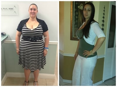 A girl who has lost weight after the obalon gastric balloon treatment with great results